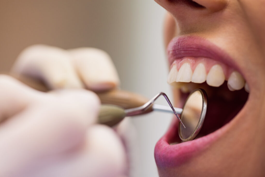 Defectos del esmalte dental