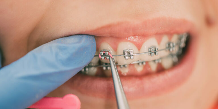 Dentist checking bracket at the braces on the female patient. Close-up. Real People.