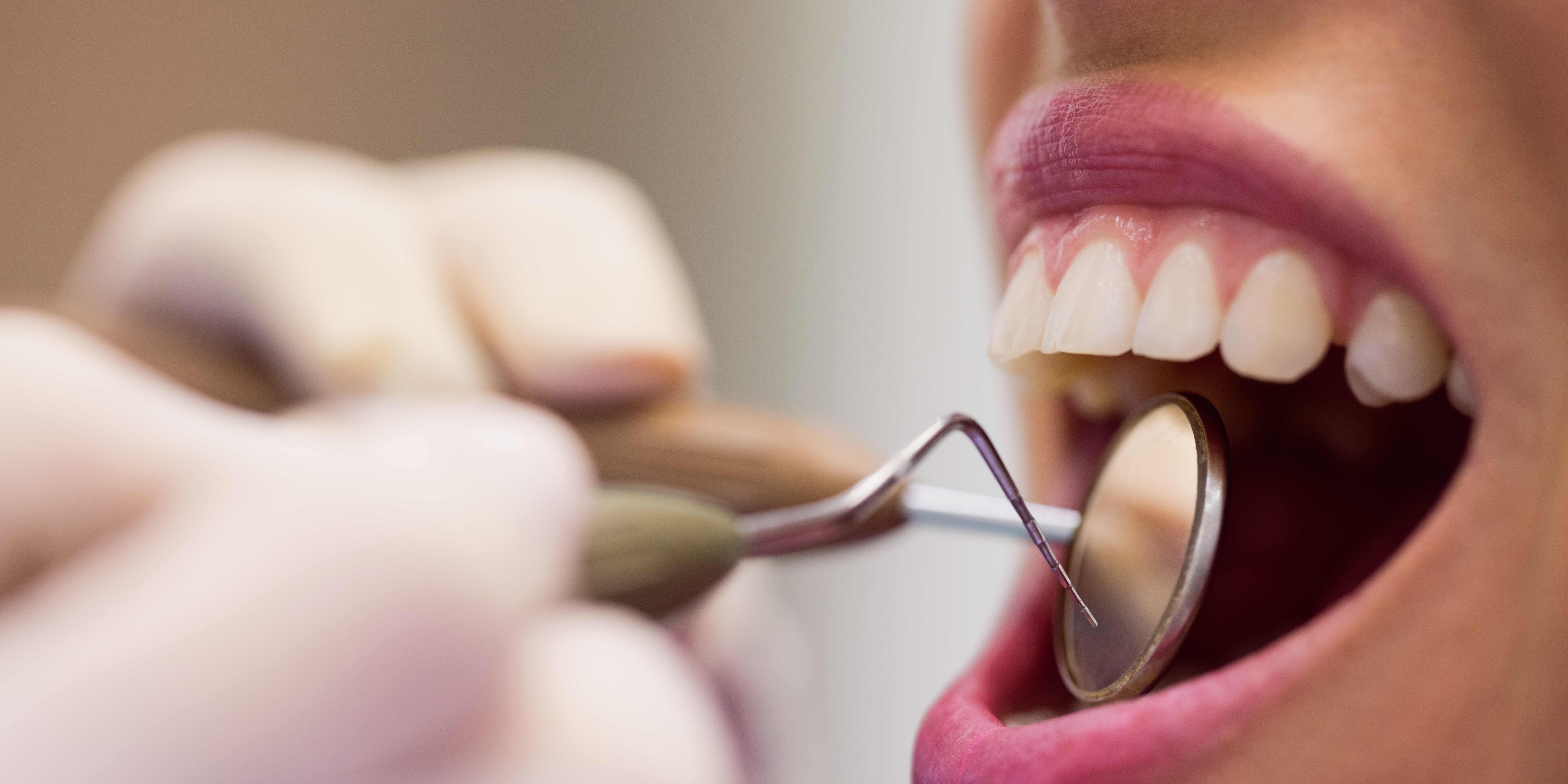 Defectos del esmalte dental